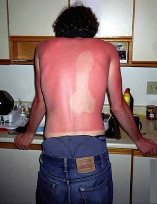 Sunburn Prank